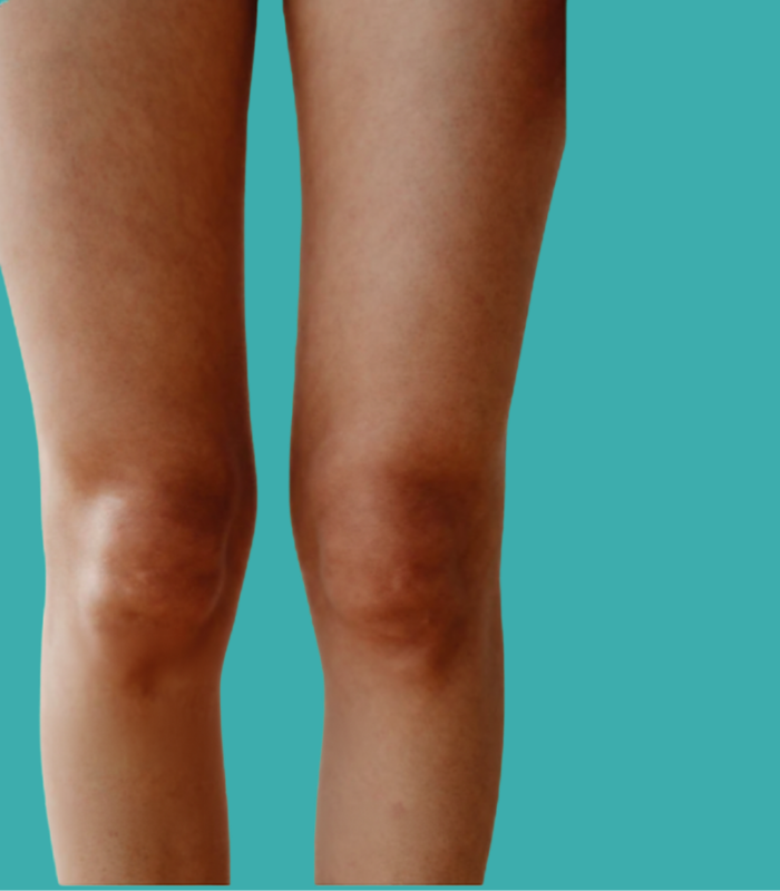 Œdème et gonflement